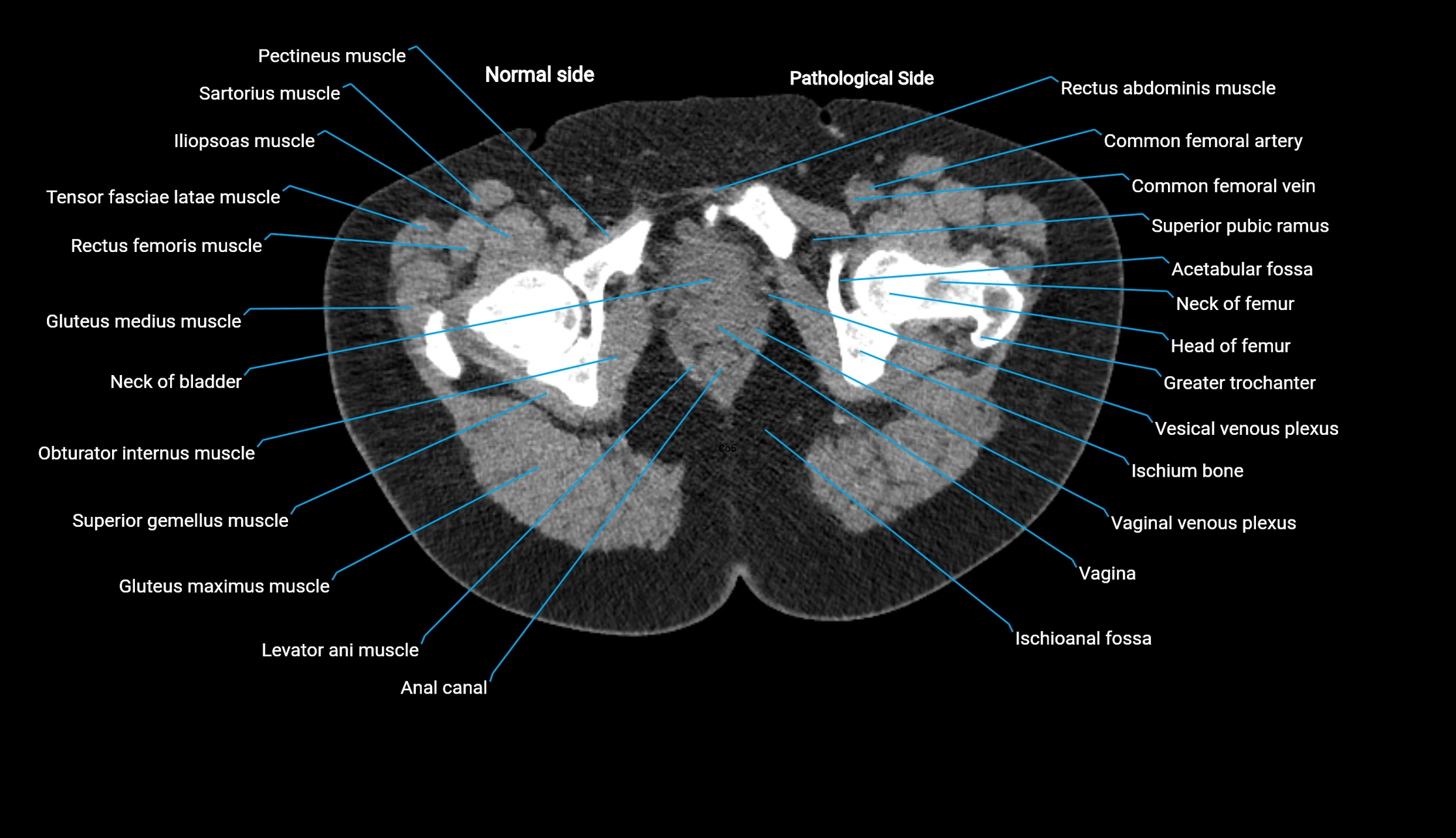 CT KUB axial cross sectional anatomy  radiology image -img-00201-00167.webp